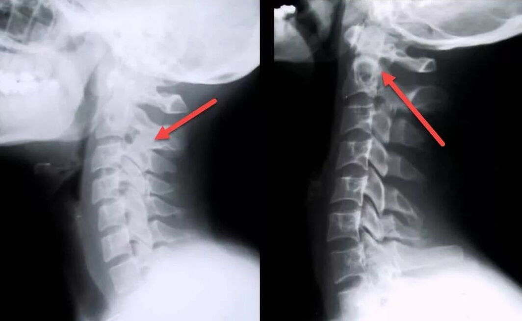 diagnostika cervikálnej osteochondrózy