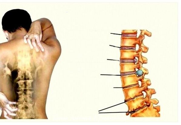 Štádiá krčnej osteochondrózy