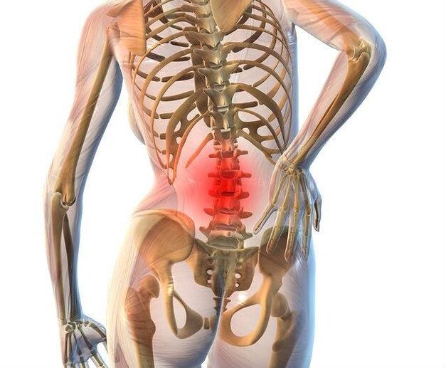 Osteochondróza bedrovej chrbtice
