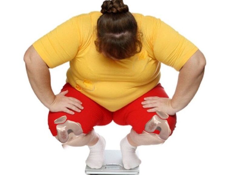 Medzi pacientmi trpiacimi artrózou je väčšina pacientov s nadváhou alebo obezitou